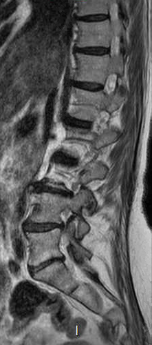 File:Chronic spinal hematoma with cauda equina syndrome (Radiopaedia 75745-87090 Sagittal T2 10).png
