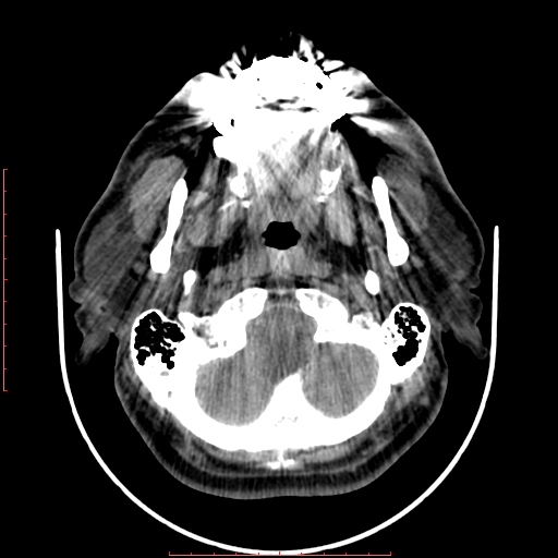File:Chronic submandibular sialolithiasis (Radiopaedia 69817-79814 Axial non-contrast 43).jpg