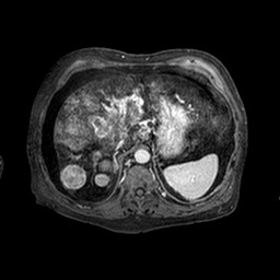 Cirrhosis and hepatocellular carcinoma in the setting of hemochromatosis (Radiopaedia 75394-86594 Axial T1 C+ fat sat 224).jpg