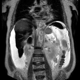 File:Cirrhosis and hepatocellular carcinoma in the setting of hemochromatosis (Radiopaedia 75394-86594 Coronal T2 18).jpg