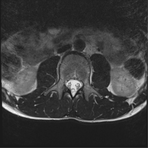 File:Clear cell meningoma - lumbar spine (Radiopaedia 60116-67690 Axial T2 30).png