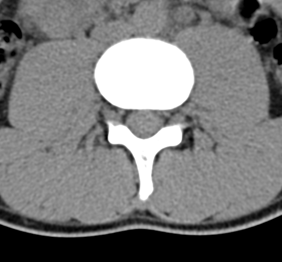 Clear cell meningoma - lumbar spine (Radiopaedia 60116-67691 Axial non-contrast 41).png