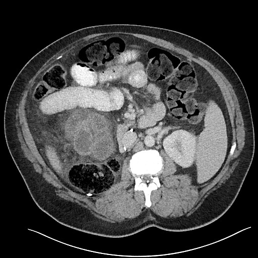 File:Closed loop obstruction - internal hernia into nephrectomy bed (Radiopaedia 59867-67320 Axial 31).jpg