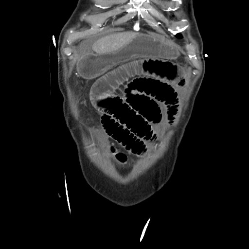 File:Closed loop obstruction due to adhesive band, resulting in small bowel ischemia and resection (Radiopaedia 83835-99023 C 23).jpg