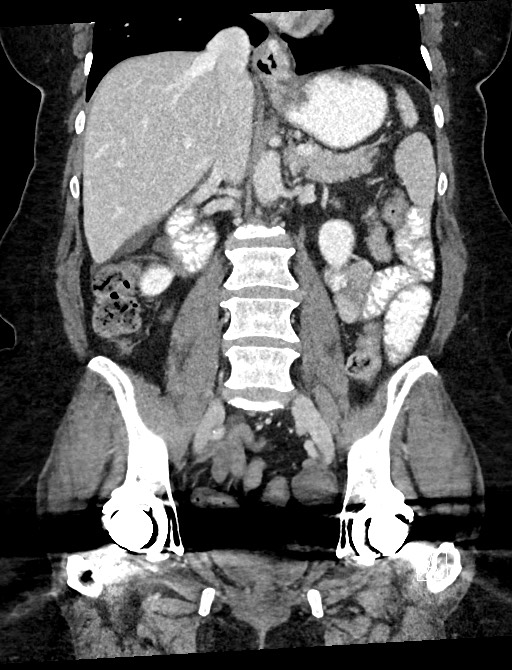 Closed loop small bowel obstruction - adhesions (Radiopaedia 59078-66369 B 70).jpg