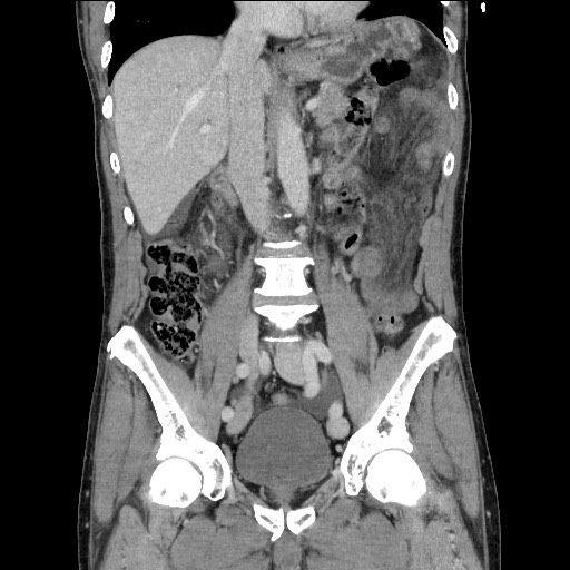 Closed loop small bowel obstruction - omental adhesion causing "internal hernia" (Radiopaedia 85129-100682 B 67).jpg