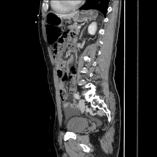 Closed loop small bowel obstruction - omental adhesion causing "internal hernia" (Radiopaedia 85129-100682 C 111).jpg