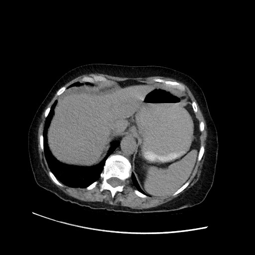 Closed loop small bowel obstruction due to adhesive band, with intramural hemorrhage and ischemia (Radiopaedia 83831-99017 Axial non-contrast 37).jpg