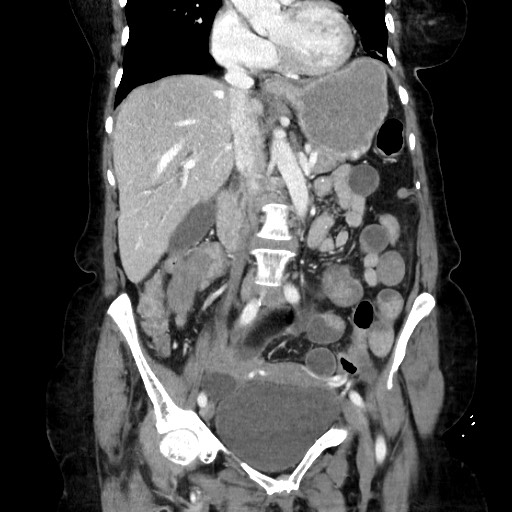 Closed loop small bowel obstruction due to adhesive band, with intramural hemorrhage and ischemia (Radiopaedia 83831-99017 C 59).jpg