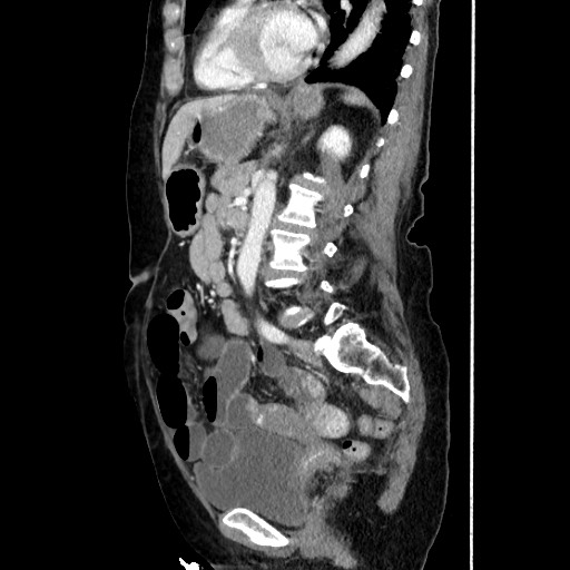 Closed loop small bowel obstruction due to adhesive band, with intramural hemorrhage and ischemia (Radiopaedia 83831-99017 D 117).jpg