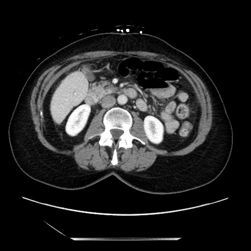 File:Closed loop small bowel obstruction due to adhesive bands - early and late images (Radiopaedia 83830-99014 A 63).jpg