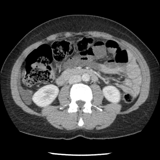 File:Closed loop small bowel obstruction due to trans-omental herniation (Radiopaedia 35593-37109 A 43).jpg