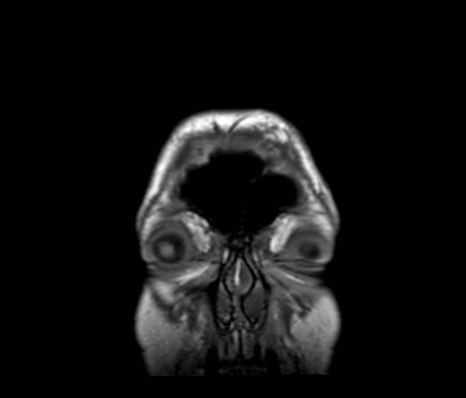 File:Cochlear incomplete partition type III associated with hypothalamic hamartoma (Radiopaedia 88756-105498 Coronal T1 62).jpg