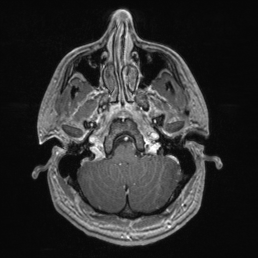 File:Colloid cyst (Radiopaedia 44510-48181 Axial T1 C+ 42).png