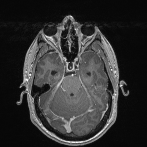 File:Colloid cyst (Radiopaedia 44510-48181 Axial T1 C+ 66).png