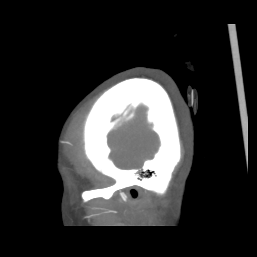 File:Colloid cyst (resulting in death) (Radiopaedia 33423-34499 B 3).png