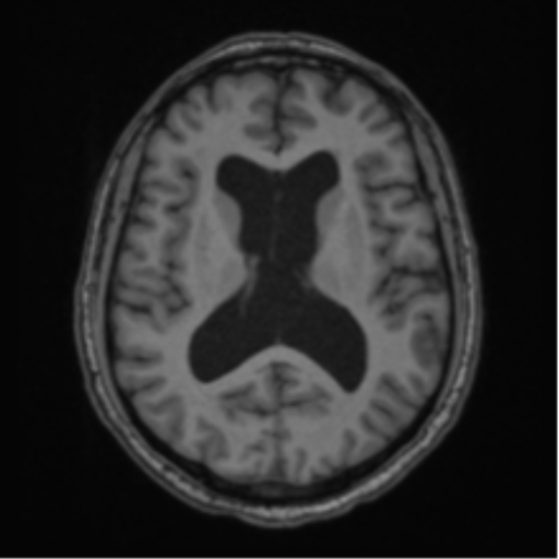 File:Colloid cyst of the third ventricle (Radiopaedia 86571-102662 Axial T1 44).png