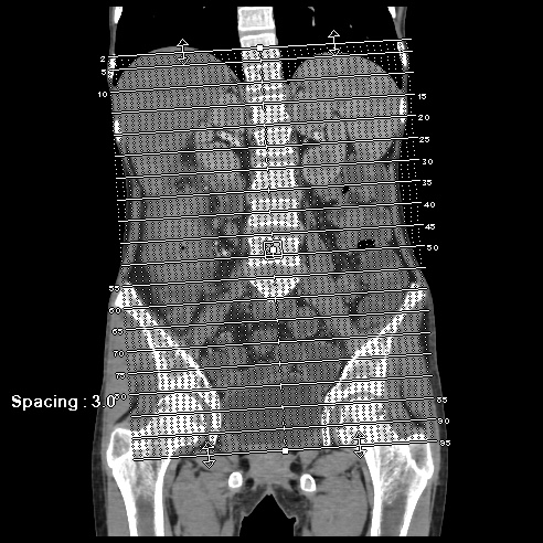 File:Colocolic fistula - Crohn disease (Radiopaedia 57063-63955 A 1).jpg