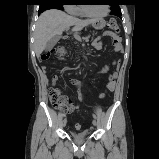 File:Colocutaneous fistula in Crohn's disease (Radiopaedia 29586-30093 Coronal non-contrast 11).jpg
