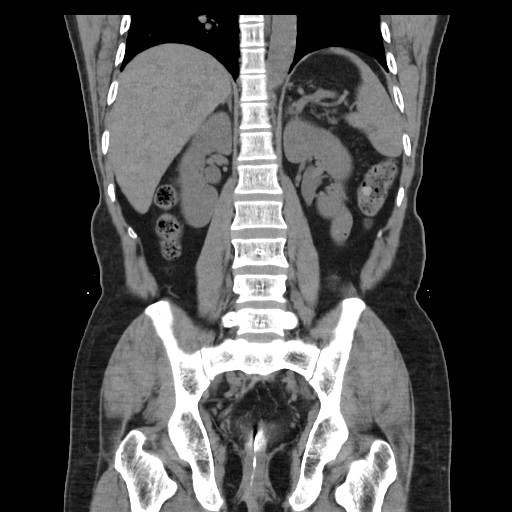 File:Colocutaneous fistula in Crohn's disease (Radiopaedia 29586-30093 E 30).jpg