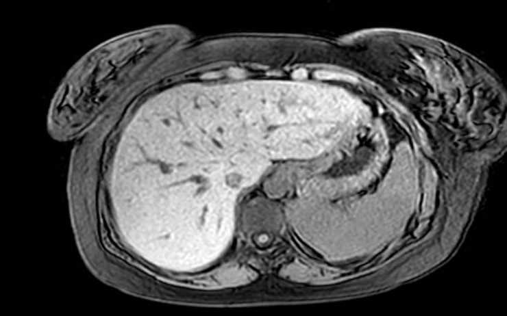 Colon adenocarcinoma with Krukenberg tumors, advanced pregnancy (Radiopaedia 67279-76645 A 70).jpg