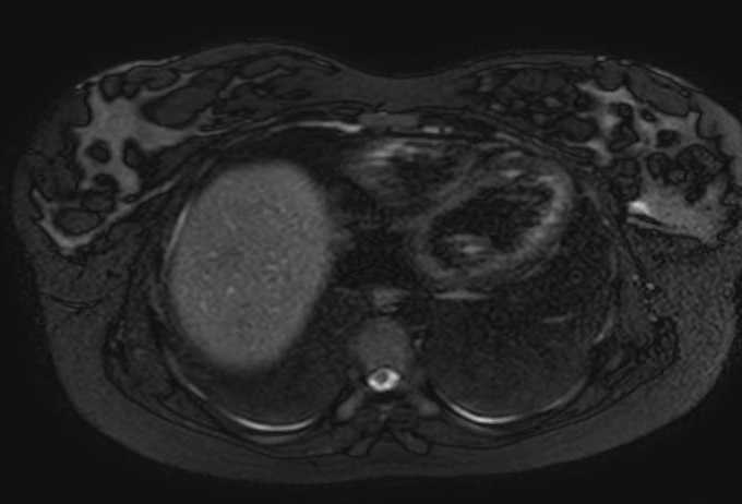 Colon adenocarcinoma with Krukenberg tumors, advanced pregnancy (Radiopaedia 67279-76645 Axial T2 SPAIR 81).jpg