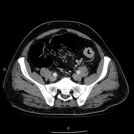 Colon adenocarcinoma with calcific liver metastasis (Radiopaedia 55745-62300 B 34).jpg