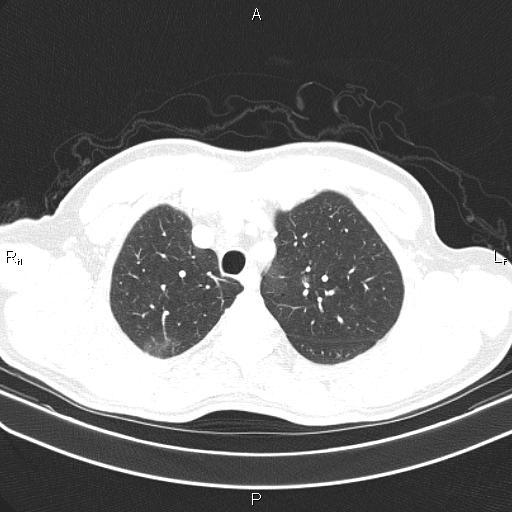 File:Colon cancer (Radiopaedia 85663-101443 Axial lung window 14).jpg