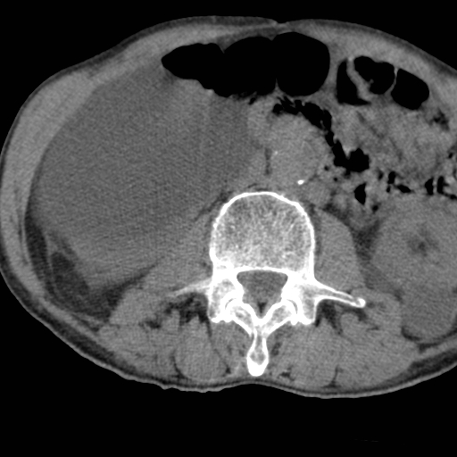 Colon cancer with calcified liver metastasis (Radiopaedia 74423-85309 Axial non-contrast 48).jpg