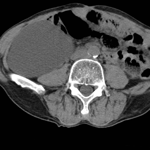 File:Colon cancer with calcified liver metastasis (Radiopaedia 74423-85309 Axial non-contrast 63).jpg