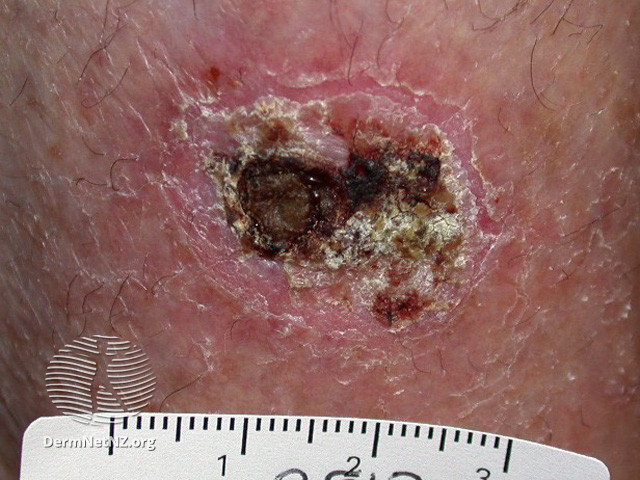 Intraepidermal carcinoma (DermNet NZ lesions-scc-in-situ-2938).jpg