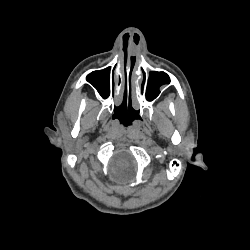 Nasal pyogenic granuloma (lobular capillary hemangioma) (Radiopaedia 85536-101244 Axial non-contrast 29).jpg
