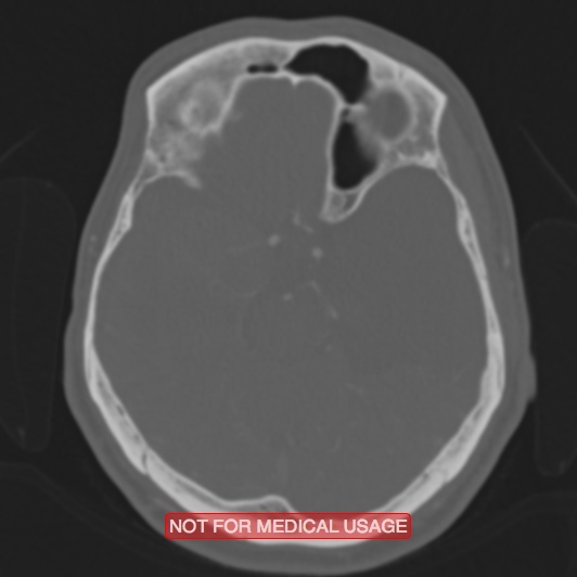 File:Nasopharyngeal carcinoma recurrence - skull base destruction (Radiopaedia 29107-29490 Axial bone window 66).jpg
