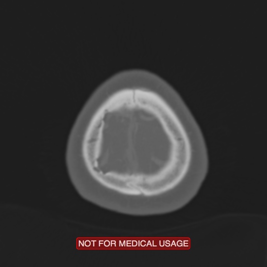 Nasopharyngeal carcinoma recurrence - skull base destruction (Radiopaedia 29107-29490 Axial bone window 9).jpg