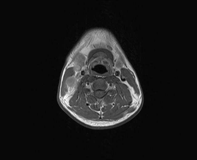 File:Nasopharyngeal carcinoma with perineural spread (Radiopaedia 55030-61380 Axial T1 13).jpg