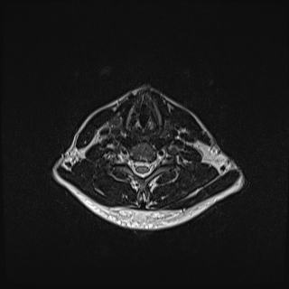Nasopharyngeal carcinoma with perineural spread (Radiopaedia 55030-61380 Axial T2 66).jpg