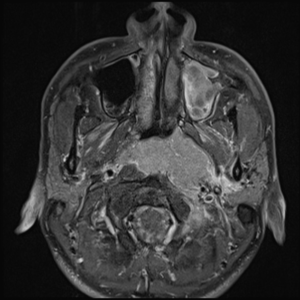 Nasopharyngeal carcinoma with skull base invasion (Radiopaedia 53415-59485 Axial T1 C+ fat sat 30).jpg