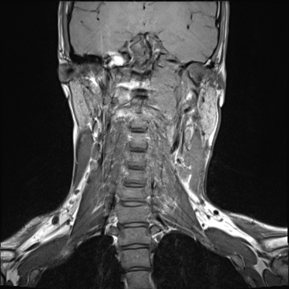 Nasopharyngeal carcinoma with skull base invasion (Radiopaedia 53415-59485 Coronal T1 15).jpg