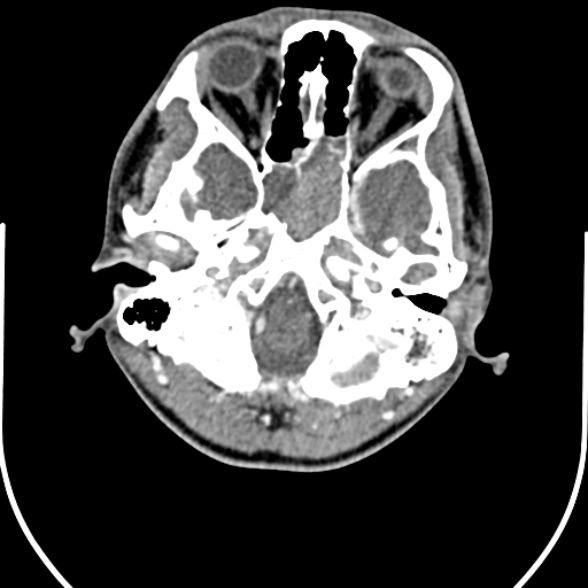 File:Nasopharyngeal carcinoma with skull base invasion (Radiopaedia 53415-59705 A 20).jpg