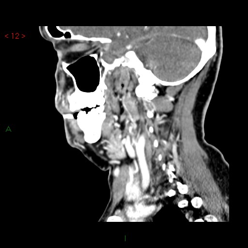 File:Nasopharyngeal lymphoma (Radiopaedia 54235-60432 B 26).jpg