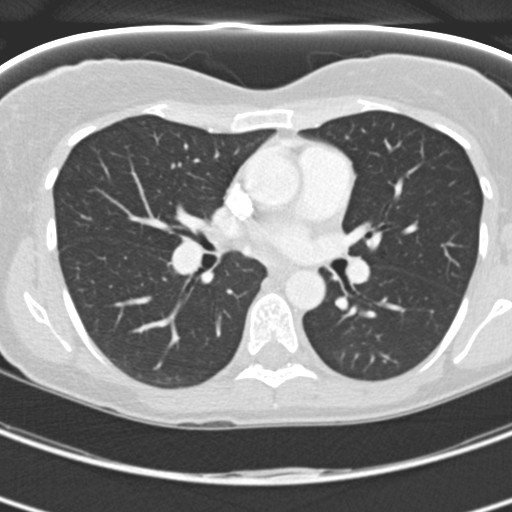 Necrobiotic pulmonary nodules - Crohn disease (Radiopaedia 20723-20631 Axial lung window 69).jpg