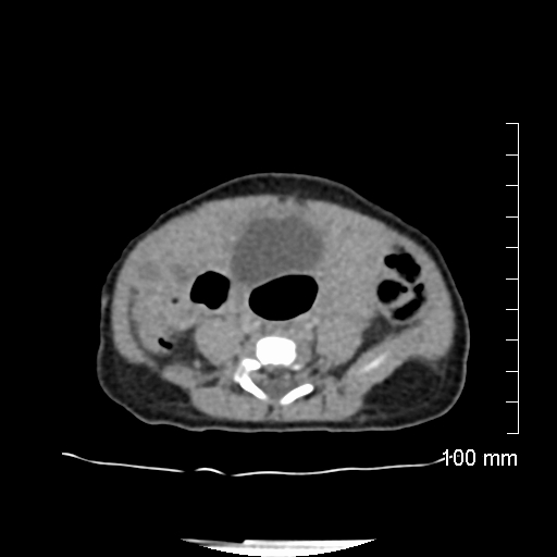 File:Neonatal neuroblastoma (Radiopaedia 56651-63438 Axial non-contrast 57).jpg