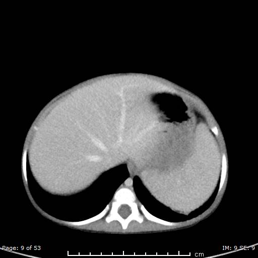 File:Nephroblastomatosis (Radiopaedia 41934-44935 A 9).jpg