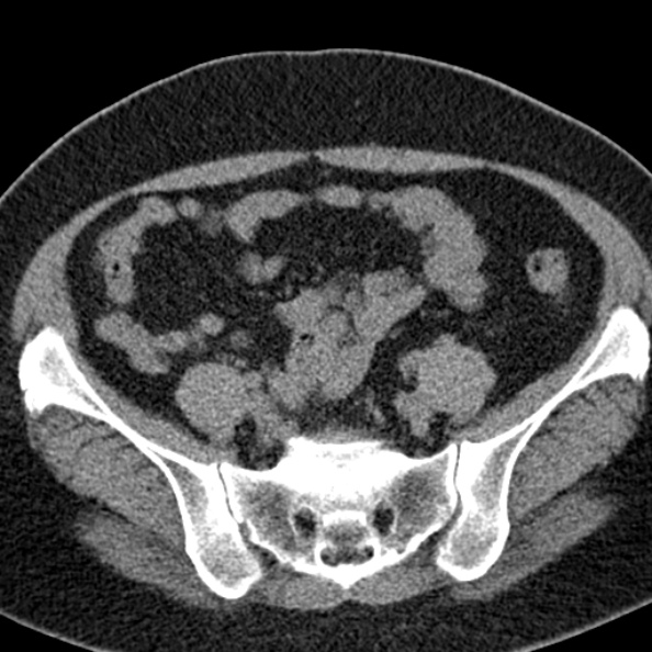 File:Nephrostomy for urosepsis (Radiopaedia 26180-26330 Axial non-contrast 47).jpg