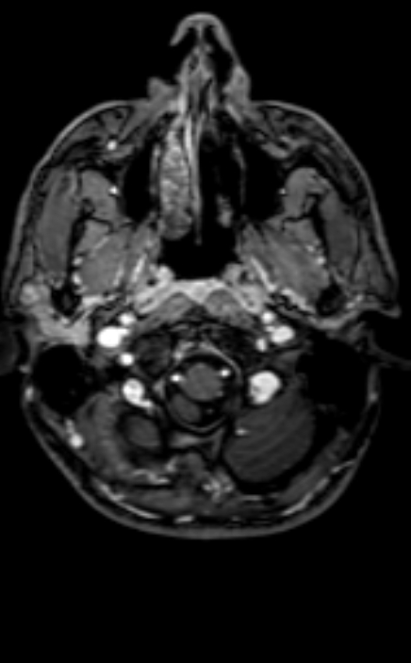 Neuro-Behçet disease (Radiopaedia 90112-107294 Axial T1 C+ 194).jpg