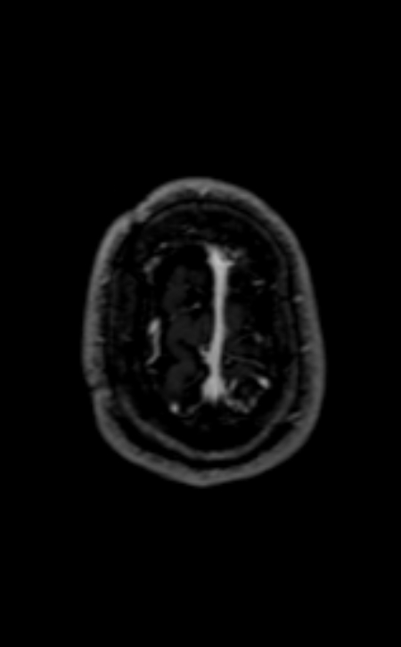 Neuro-Behçet disease (Radiopaedia 90112-107294 Axial T1 C+ 57).jpg