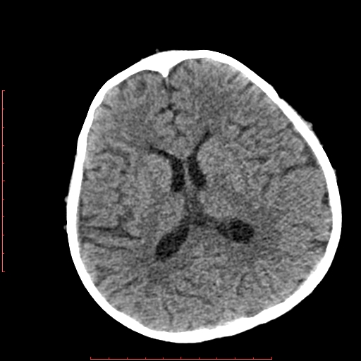 File:Neuroblastoma skull metastasis (Radiopaedia 56053-62683 Axial non-contrast 10).jpg
