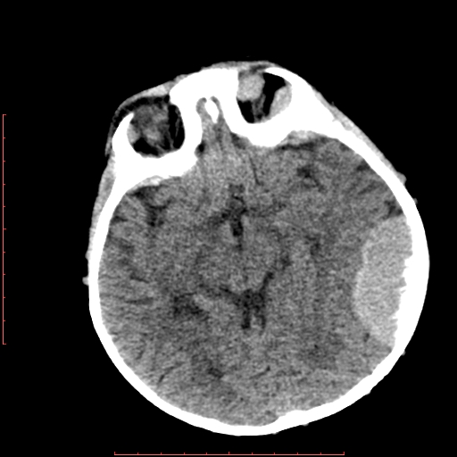 File:Neuroblastoma skull metastasis (Radiopaedia 56053-62683 Axial non-contrast 8).jpg
