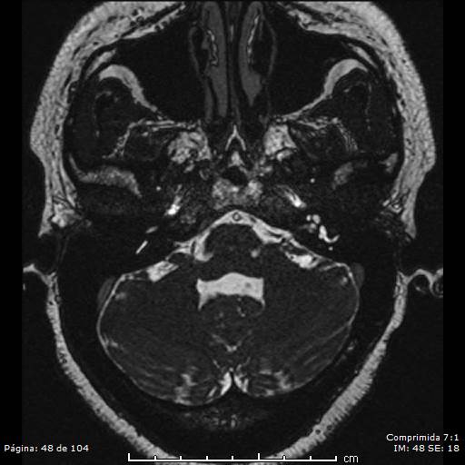 Neurocysticercosis (Radiopaedia 58636-65832 I 48).jpg