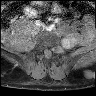 File:Neurofibromatosis type 1- extensive spinal involvement and Christmas tree sign (Radiopaedia 60610-68332 Axial T1 C+ fat sat 43).jpg